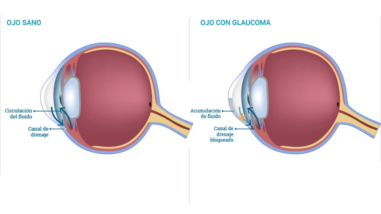 Latanoprost for Pediatric Glaucoma: A Comprehensive Guide